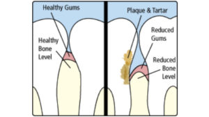 Collegeville Gentle Dentist gum disease treatment